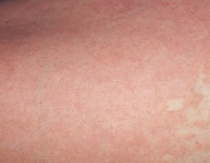 handheld phototherapy lamps