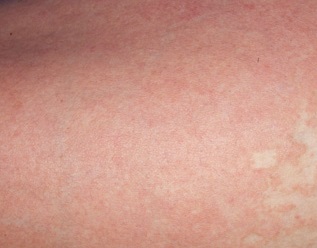 Increasing the Effects of Phototherapy on Psoriasis - Favoriteplus.com Blog