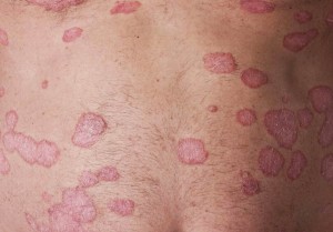 psoriasis treatment
