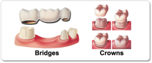 favoriteplus dental bridges and crowns