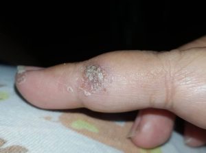 atopic dermatitis favoriteplus