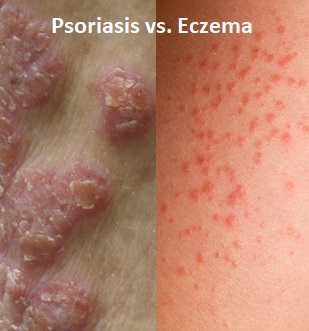 eczema vs psoriasis