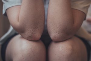 skin tags FavoritePlus