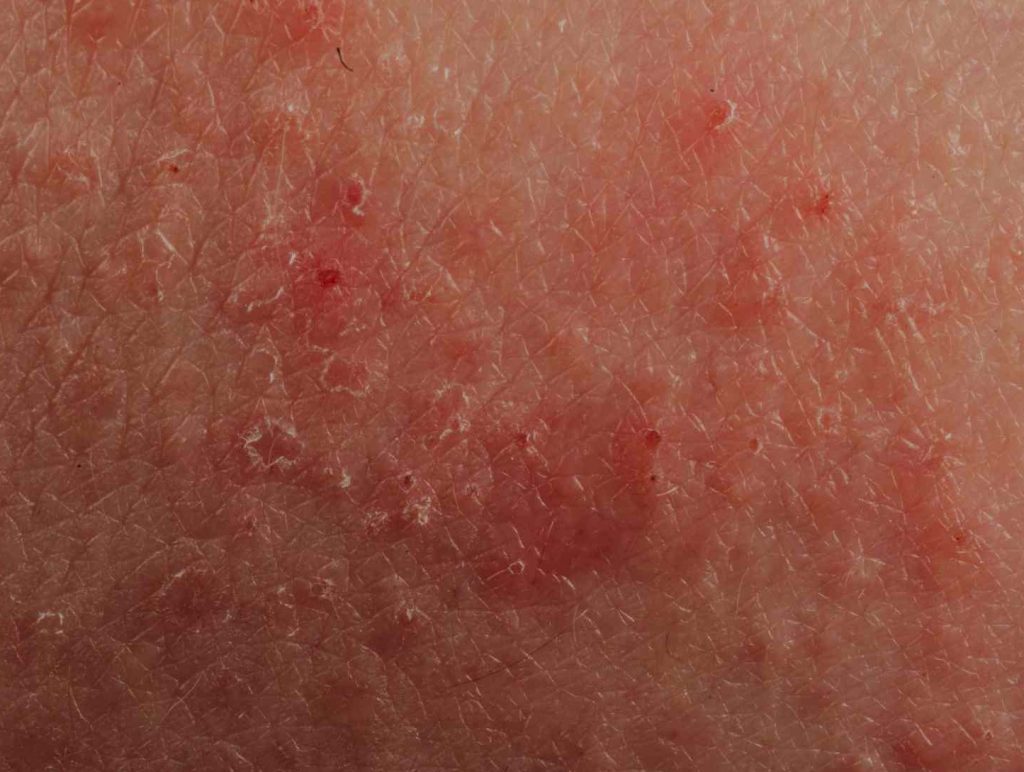 stop eczema itching